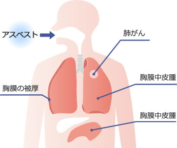 アスベストが人体に及ぼす影響